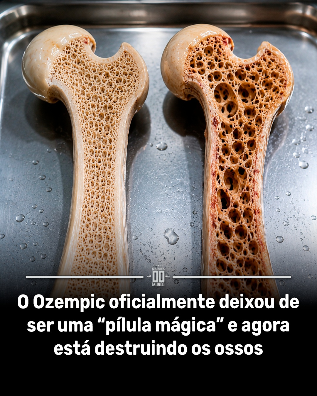 Ozempic e outros medicamentos da classe GLP-1 voltaram ao centro do debate, mas agora por um motivo menos glamouroso: a saúde dos ossos