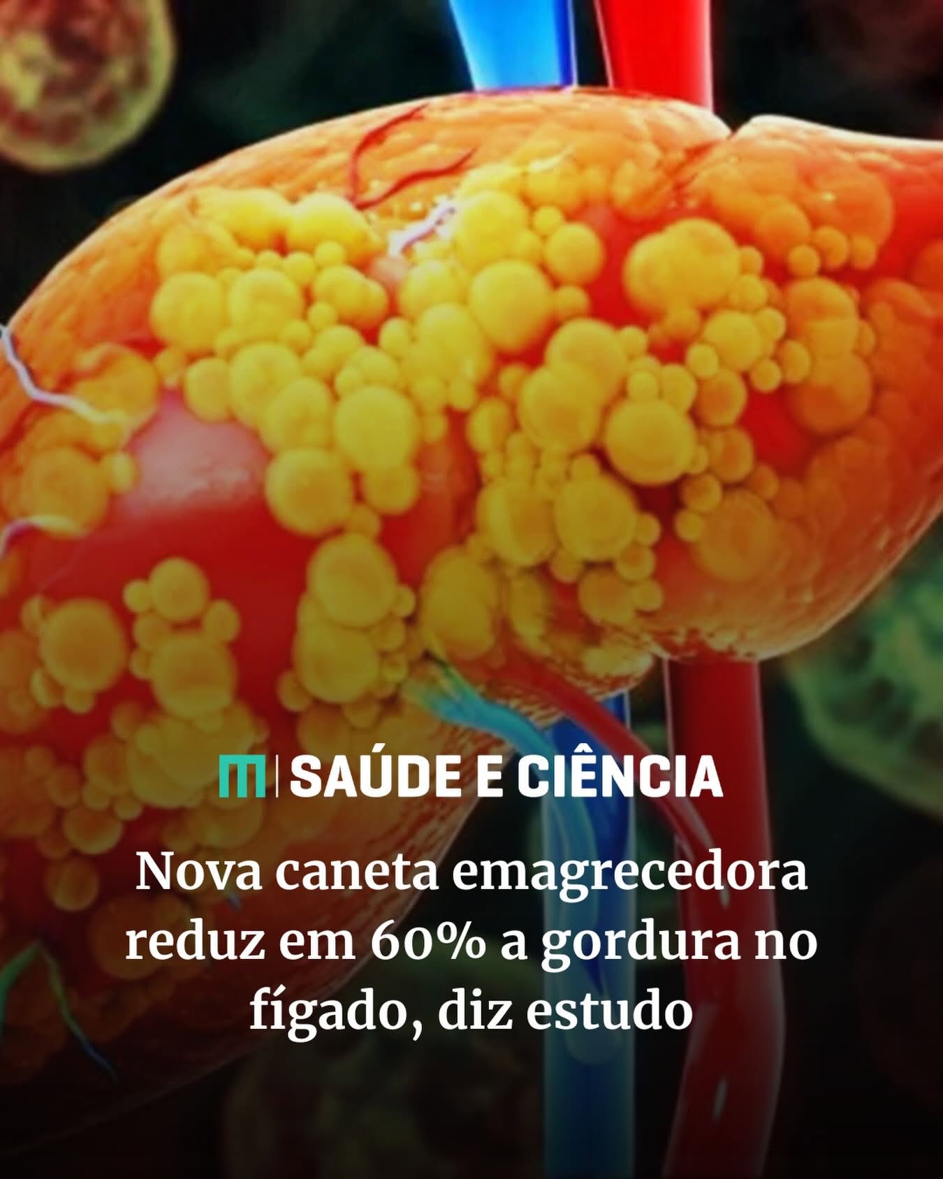 Nova caneta emagrecedora reduz em 60% gordura no fígado, diz estudo